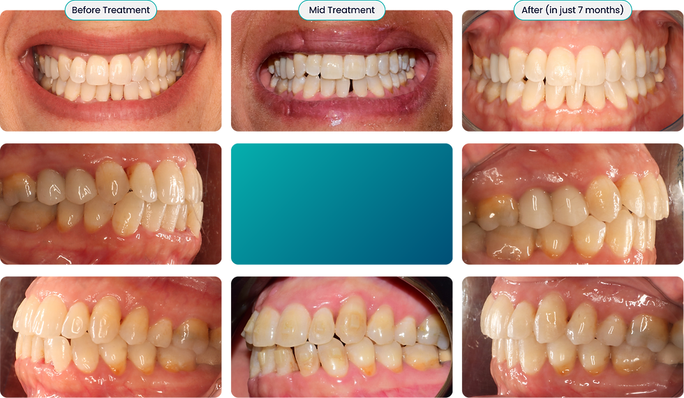 Dental treatment progression collage showing teeth alignment before, mid, and after in 7 months, with labeled before/mid/after photos