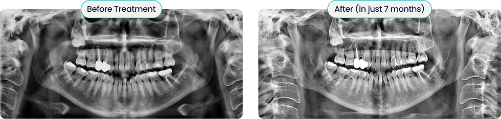 Side-by-side dental X-rays labeled Before Treatment and After (in just 7 months), showing straighter teeth and improved alignment.