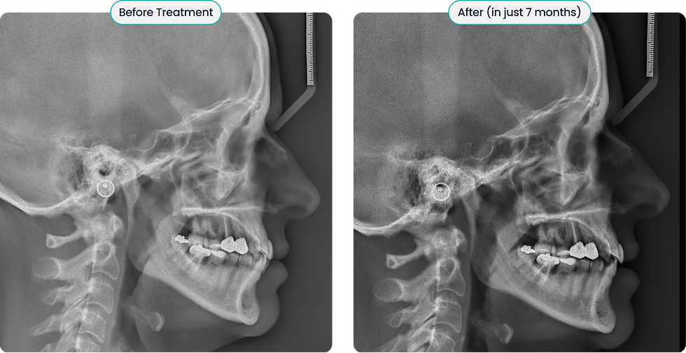 Side-by-side skull X-rays show jaw alignment improved after 7 months, labeled Before Treatment and After (in just 7 months).