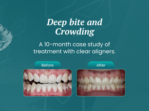 A teal graphic showing information about a 10‑month clear aligner case study for deep bite and crowding, with two blurred before‑and‑after dental photos and a note that a new article is live on the Knowledge Center.