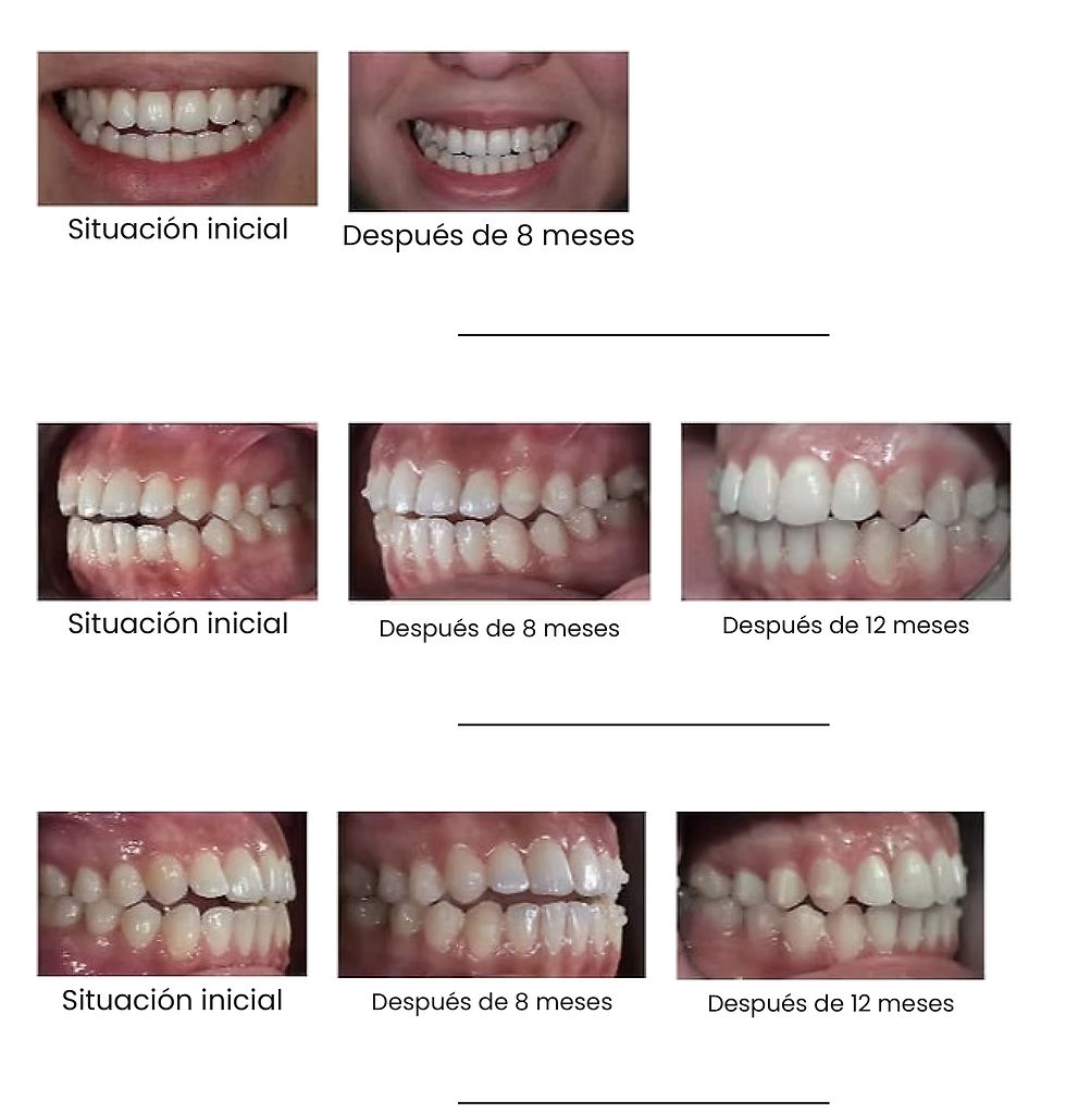 Dientes antes y después a lo largo de 12 meses. Arriba, la sonrisa; debajo, vistas laterales. Texto: Situación inicial, Tras 8 meses, Tras 12 meses.