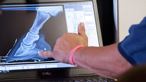 How To Use Self Adjusting Palmar Angles To Treat Heel Pain