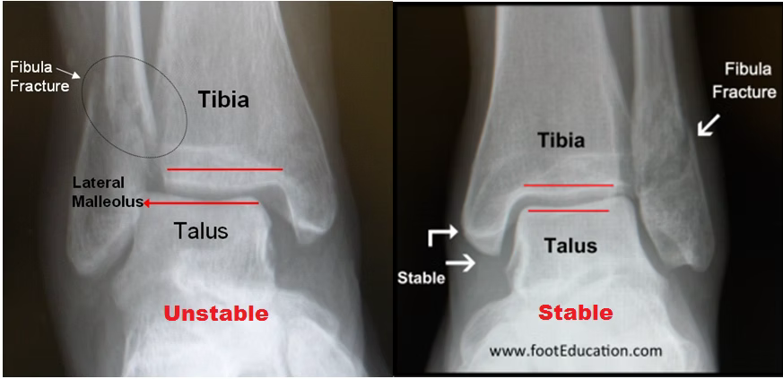 Stable and Unstable Lateral Malleolus Fracture