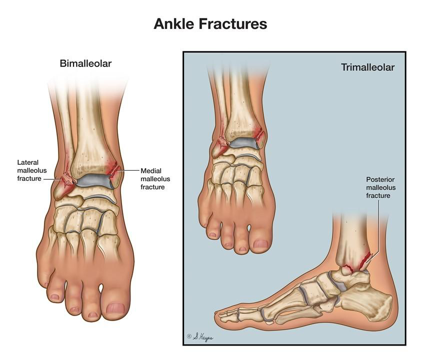Bimalleolar and trimalleolar ankle fracture