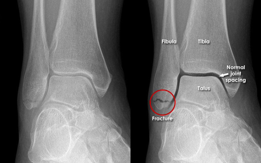Fibula Avulsion Fracture