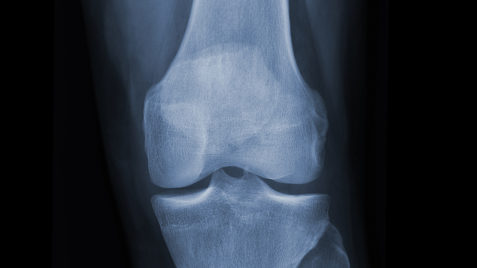 Side-view X-ray of an elbow with a bright metal joint replacement on a black background.