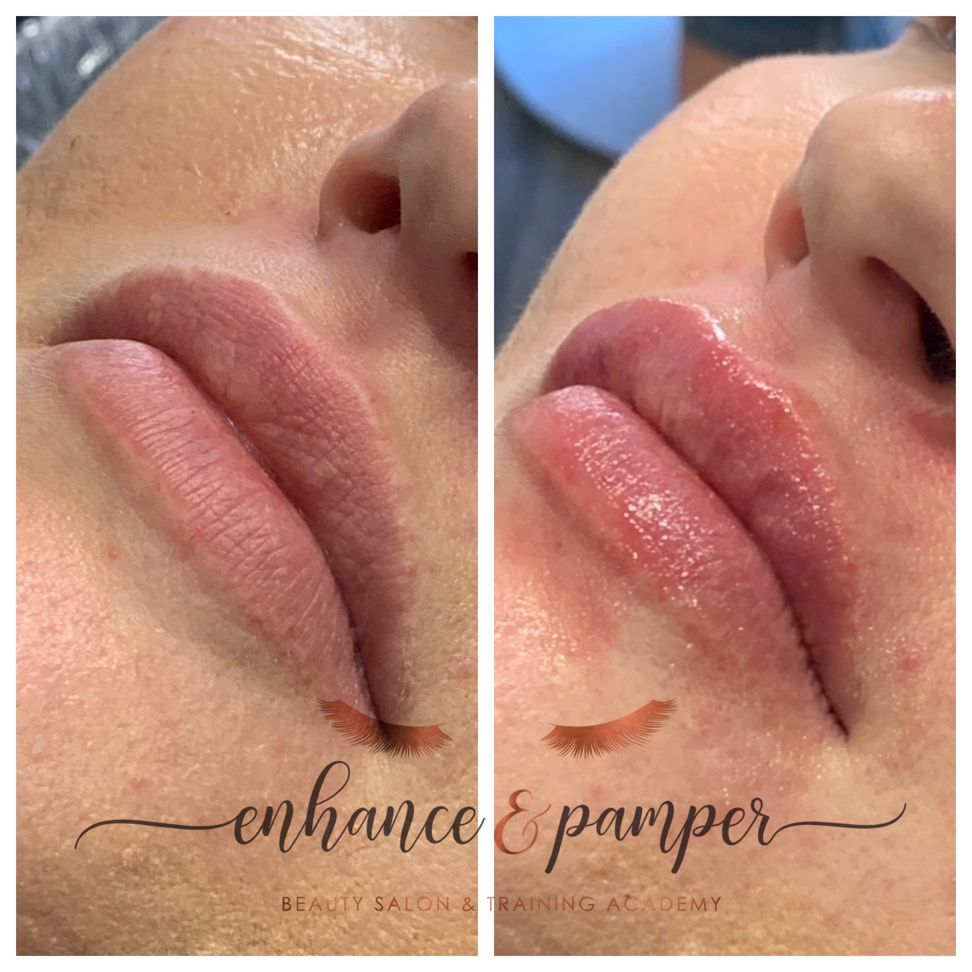 lip filler near me lip filler near me