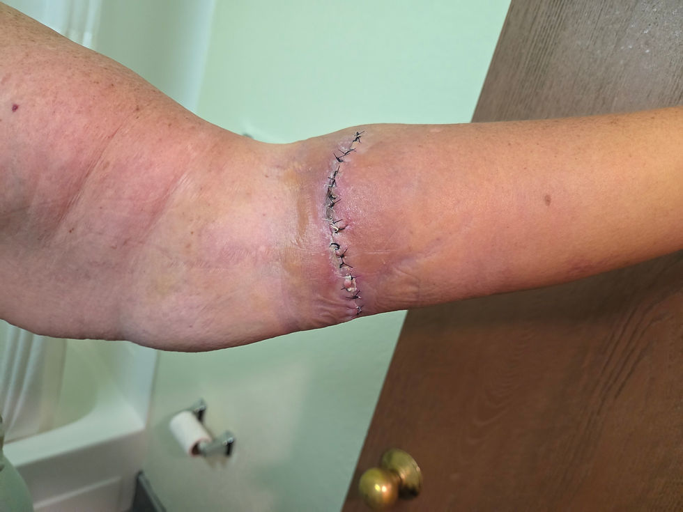 One week today. Swelling is going down, as is the discoloration. That's gonna leave a mark...