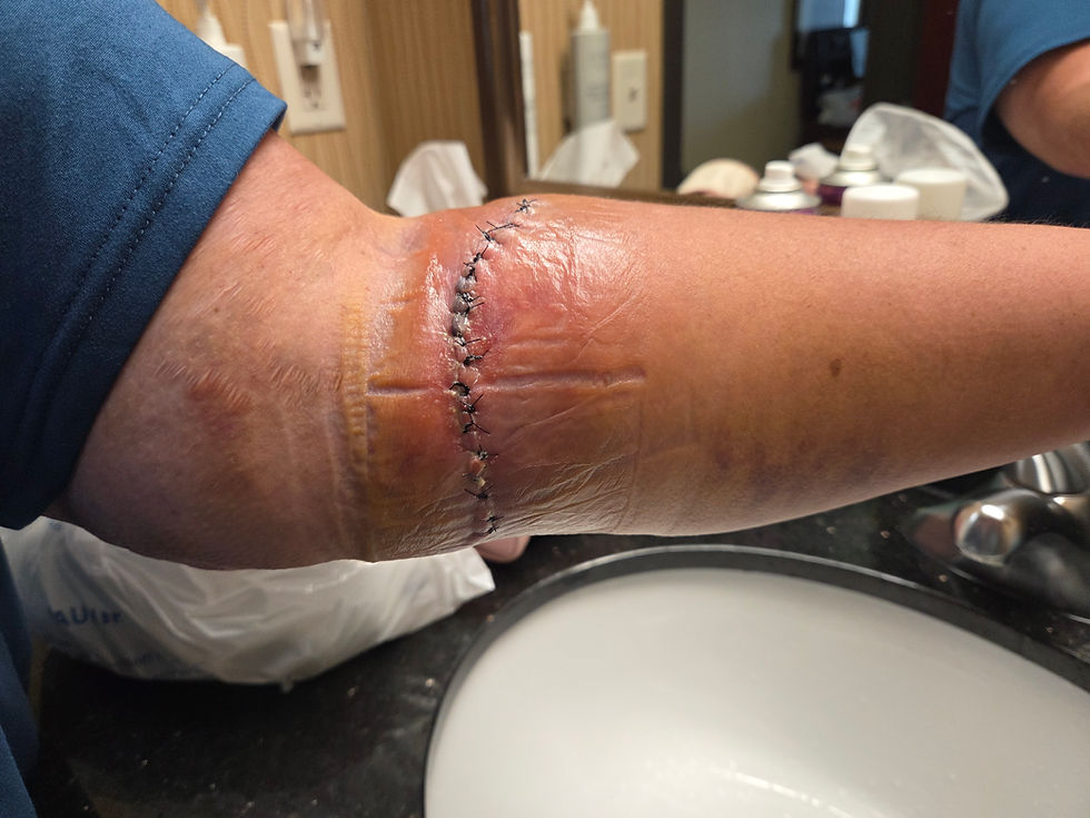 Saturday night. The swelling is definitely going down. We just have to make up a good story: Julie was surfing in Nebraska and a shark jumped out of the corn field and bit her arm! That'll do.