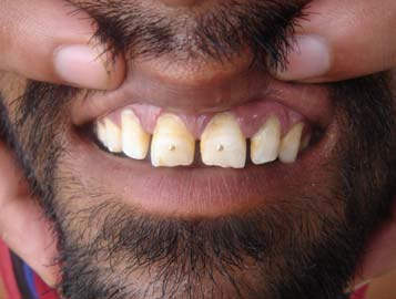Incrustation de de points dor dans les dents. Tradition du choump en Inde