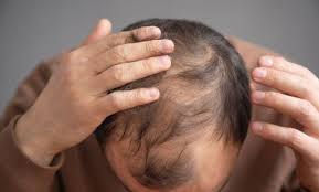 CAÍDA DEL CABELLO: ALERTA DE SALUD MÁS ALLÁ DE LO ESTÉTICO, ADVIERTEN ESPECIALISTAS