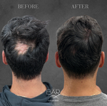 scalp micropigmentation photo editing the bar aesthetics