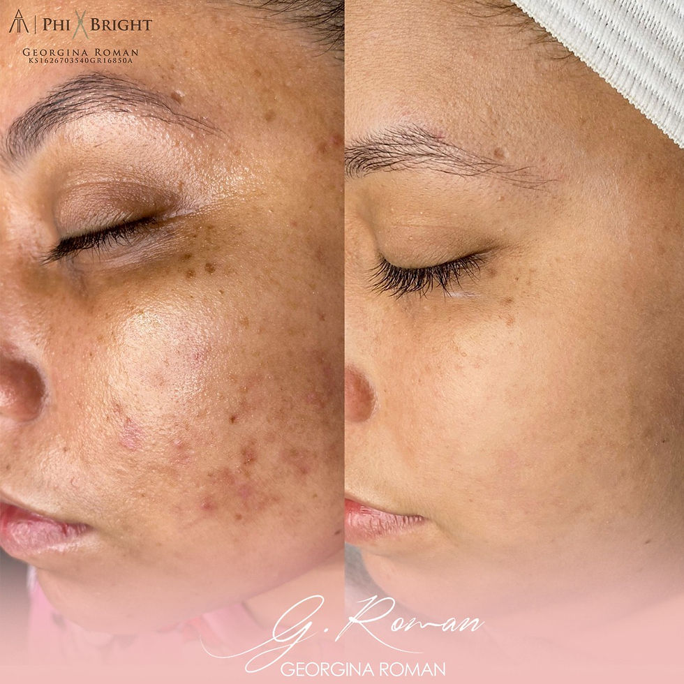 antes-y-despues-limpieza-facial
