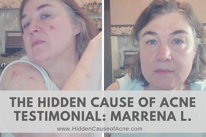 Hidden Cause of Acne fluoride testimonia