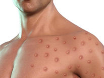 MONKEY POX