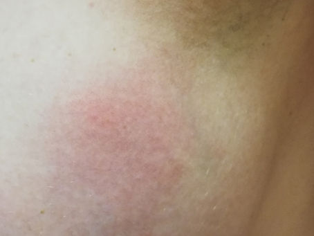 L'abcès mammaire, une urgence