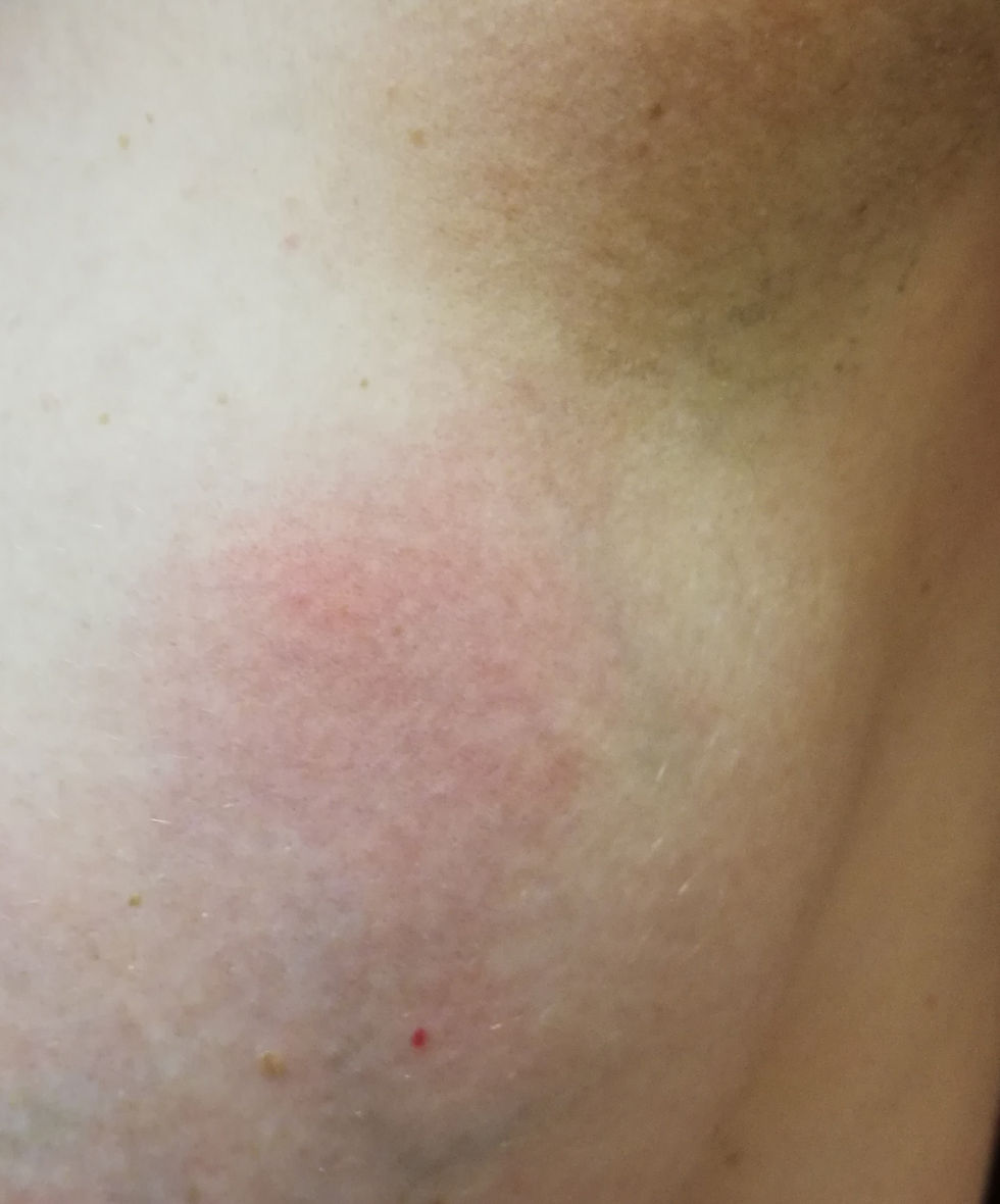 L'abcès mammaire, une urgence