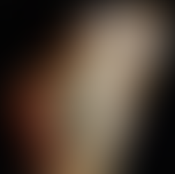 Pre-shaping: revolutionizing the treatment of severe and complex chest wall deformities