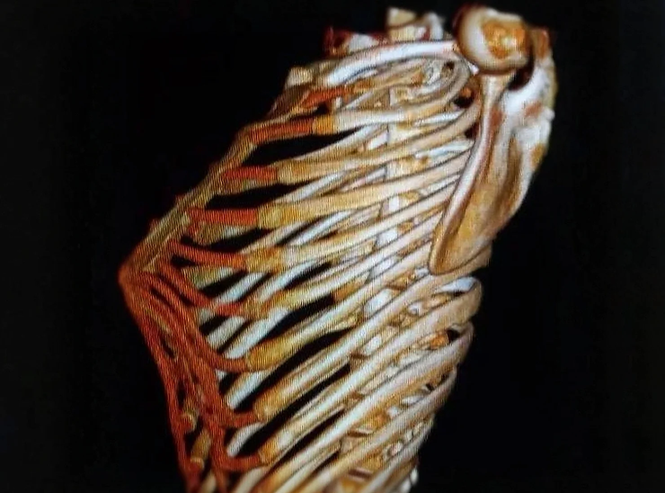 severe pectus carinatum