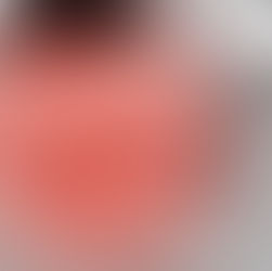 Nuss术后的胸廓出口综合征