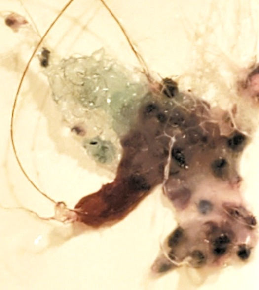 Neurological Symptoms from the Parasite in your Hair