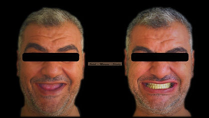 فينير الاسنان.jpeg