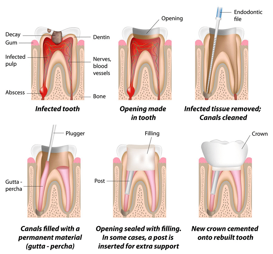 process of root canal treatment