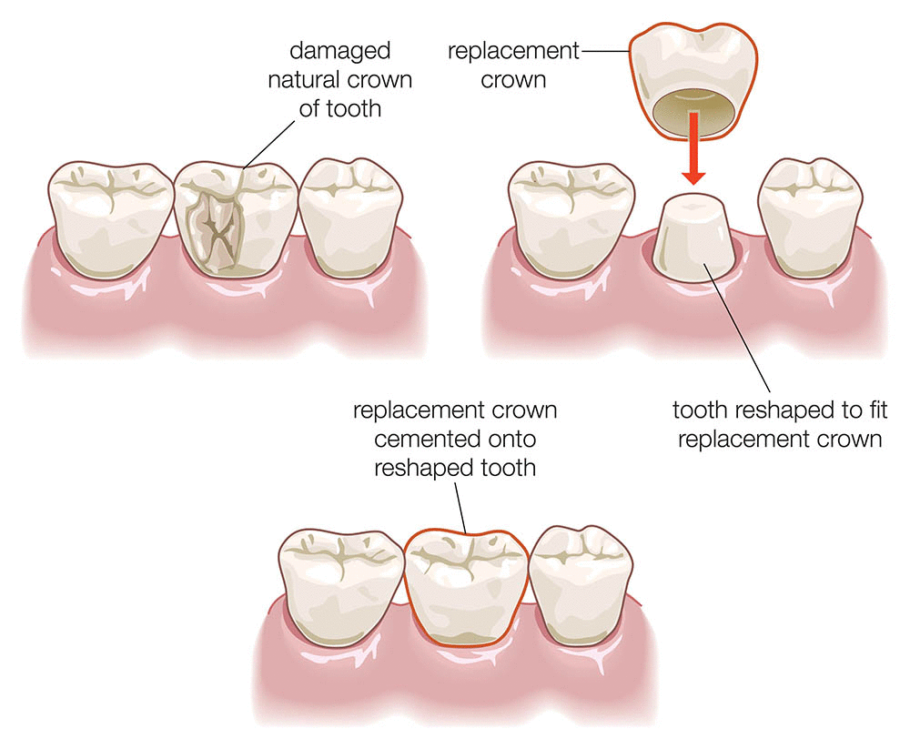 single crown for fragile tooth