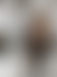 Laser Hair Removal with Semper Laser ( My Experience)