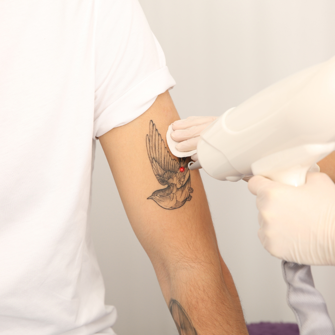 Tattoo Removal