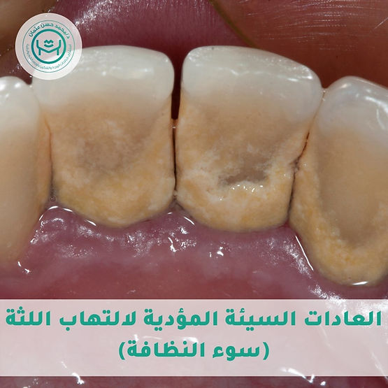 التهاب اللثة