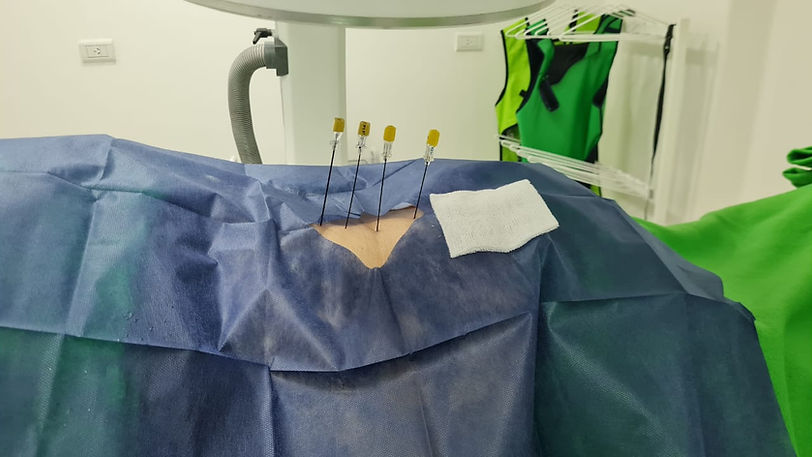 sindrome facetario lumbar (2).jpeg