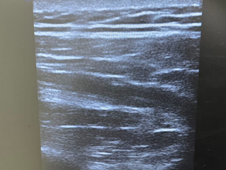 Paciente tenista con dolor en hombro derecho