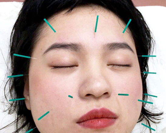 美顔鍼