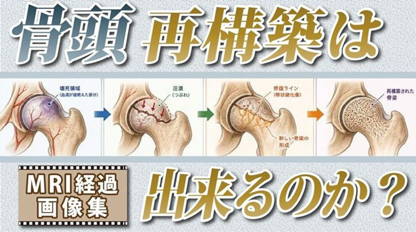 骨頭再構築できるか