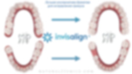 Invisalign элайнеры.jpeg