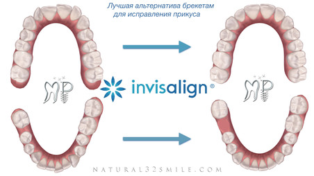 Invisalign элайнеры.jpeg