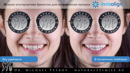 прозрачные элайнеры Invisalign.jpeg