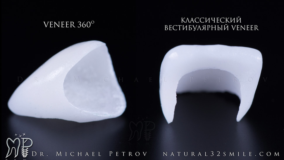 винир 360 люминир.jpeg