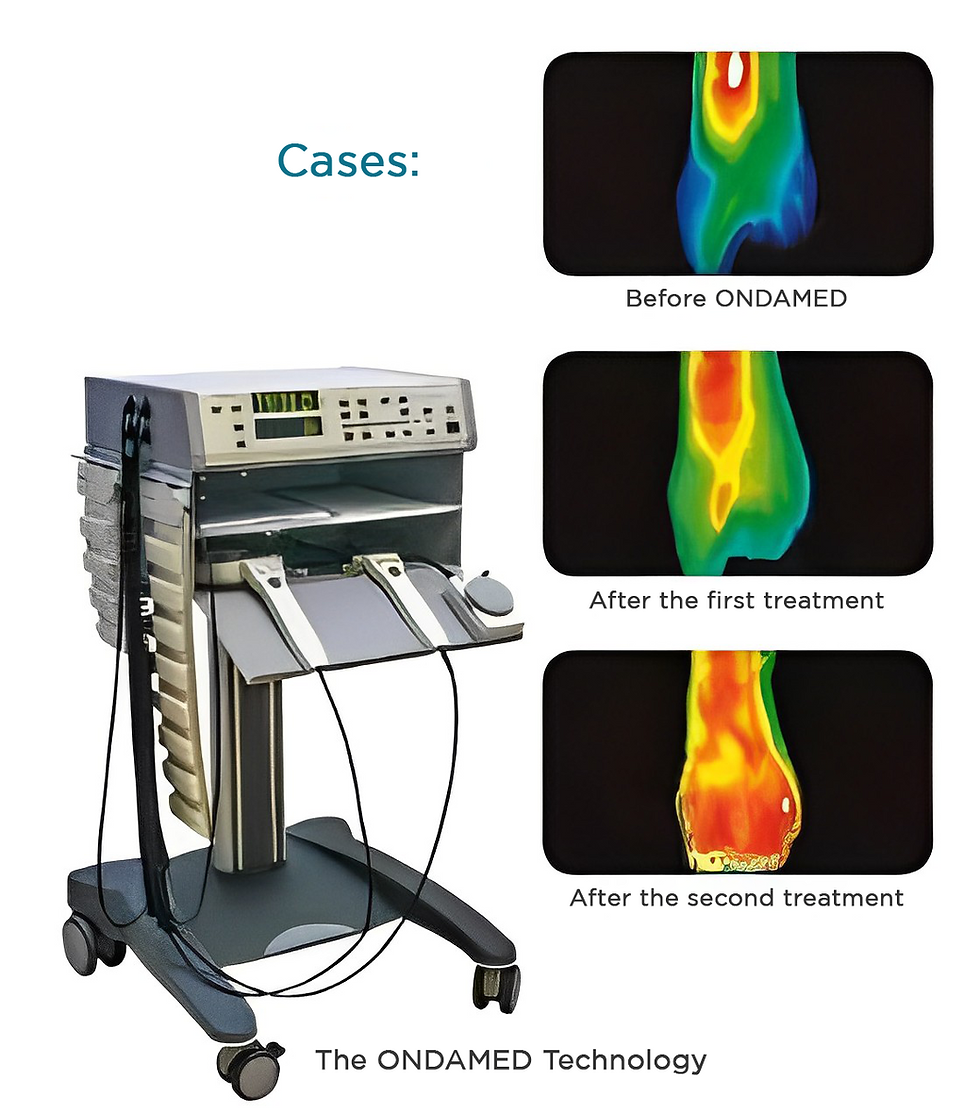 ONDAMED machine with screens showing thermal images labeled "Before ONDAMED," "After the first treatment," and "After the second treatment."