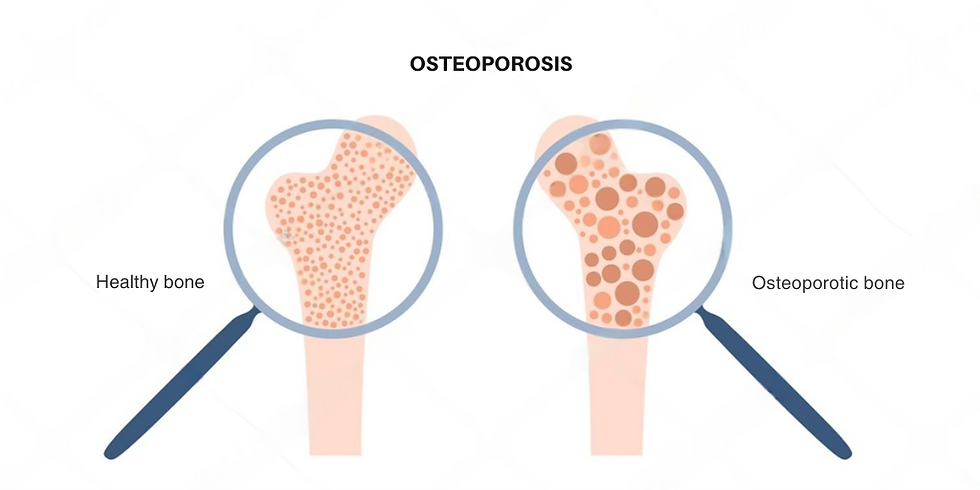 Illustration comparing a healthy bone to an osteoporotic bone, magnified. "Osteoporosis" title above. Notable bone texture differences.