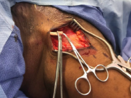 A SERIES OF 55 PATIENTS UNDERGOING HeRO GRAFT PLACEMENT WITH TIPS AND TRICKS FOR SUCCESS