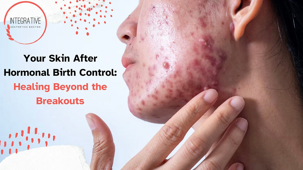 Close-up of a person's cheek with acne, hand touching face. Text: Your Skin After Hormonal Birth Control: Healing Beyond the Breakouts at Integrative Aesthetics Boston.