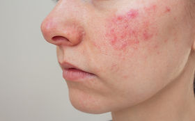 glutathione and rosacea Boston's Best Rosacea Solutions | Integrative Aesthetics Boston| Holistic  Dermatology Boston