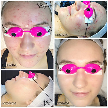 Acne Treatment Boston Before-After Teenager