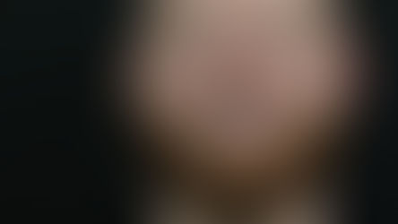 Are Zirconium Crowns Safe?