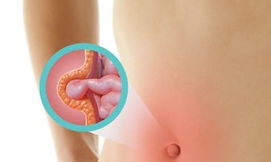 Hernia Umbilical
