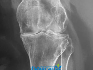 SE REALIZÓ EL PRIMER REEMPLAZO PARCIAL O UNICOMPARTIMENTAL DE RODILLA EN EL HOSPITAL MUNICIPAL DE DAIREAUX