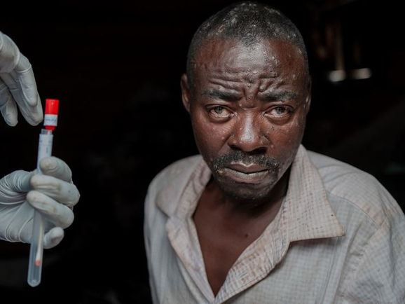 OMS está investigando um surto de uma doença de origem desconhecida que já causou 79 mortes na República Democrática do Congo