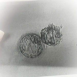 Our Mosaic Embryo Story: Why We Chose Hope.
